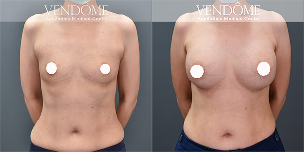 Mentor曼陀女王波隆乳手術、價格、費用