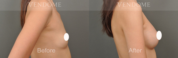 【珍珠波】 PERLE 最新隆乳材質