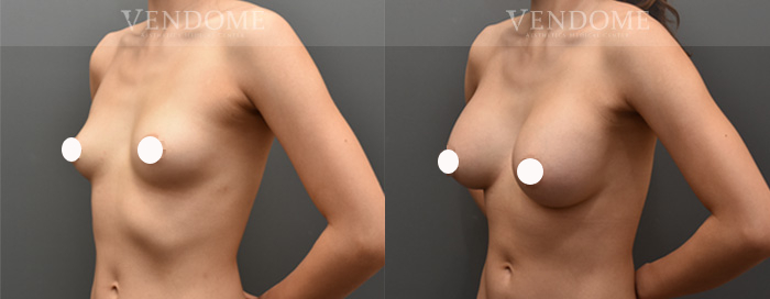 女王波-曼陀Mentor隆乳