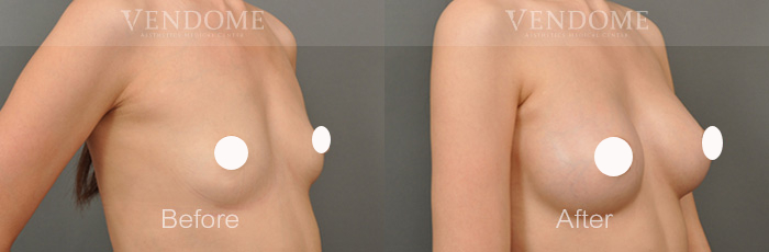 PERLE珍珠波隆乳