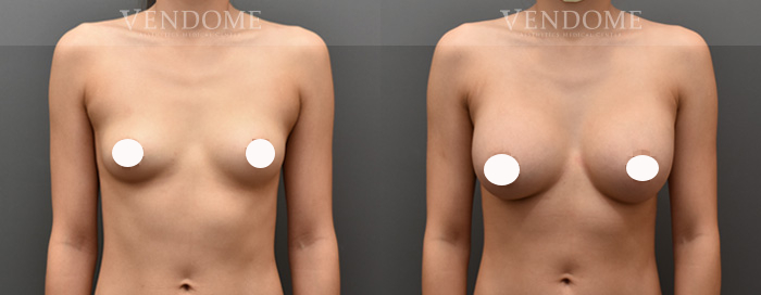 女王波隆乳是什麼？曼陀女王波優點、費用與術後保養