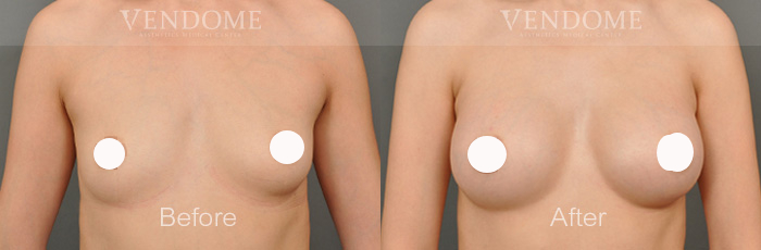 PERLE 珍珠波隆乳