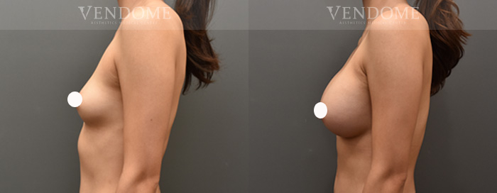 女王波是什麼？隆乳費用、材質、尺寸與術後照護技巧