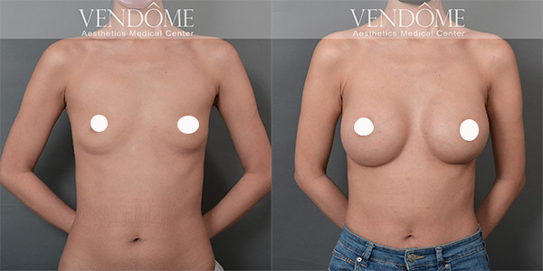 女王波隆乳手術 新一代的矽膠義乳材質