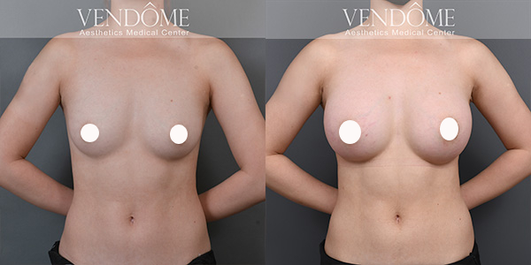 PERLE珍珠波隆乳-細緻柔軟自然+終生保固