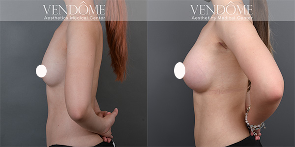 PERLE珍珠波隆乳案例分享