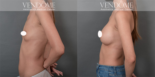 女王波隆乳手術