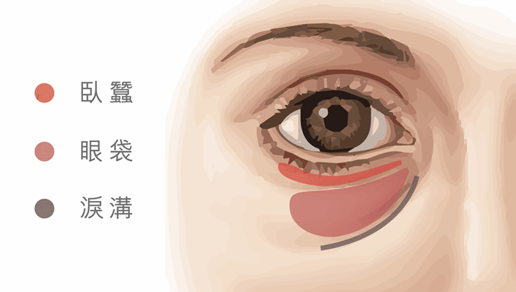 什麼是眼袋？眼袋、淚溝、臥蠶介紹