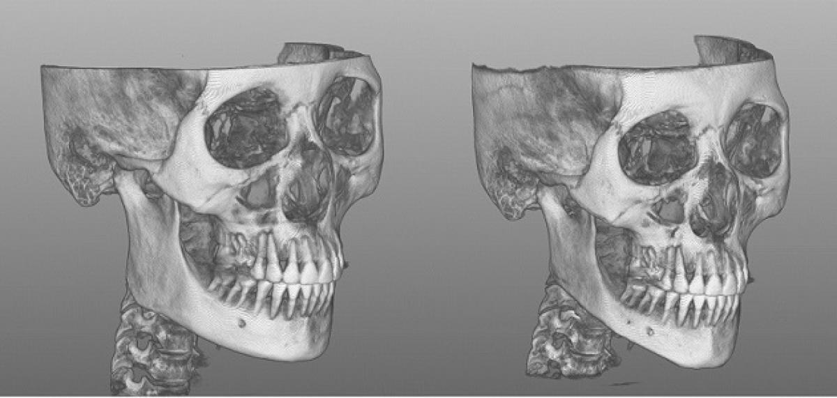 V-Line 與下顎線條示意