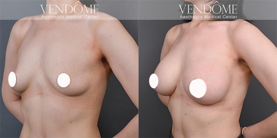 英國珍珠波乳房整形