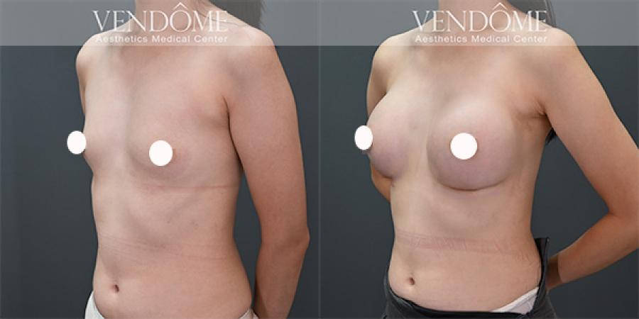 Mentor 曼陀- 女王波隆乳假體隆乳怎麼選？