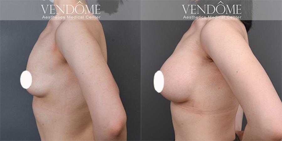 珍珠波隆乳與盈波差別在哪？