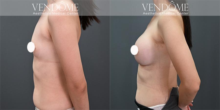 了解曼陀女王波5大特點、優缺點、材質比較、價格區間