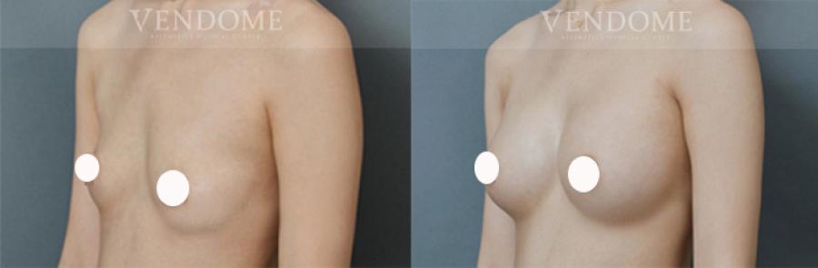 魔滴隆乳費用解析 推薦理由