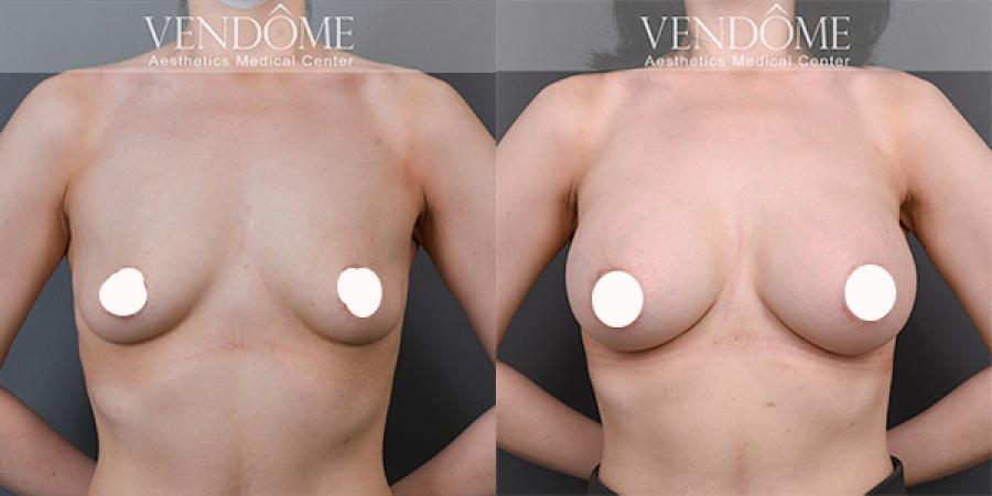 PERLE珍珠波隆乳假體