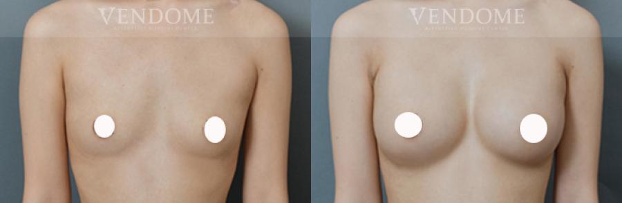 魔滴隆乳-觸感與真實乳房相似