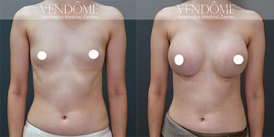 曼陀女王波隆乳價格、優缺點、案例