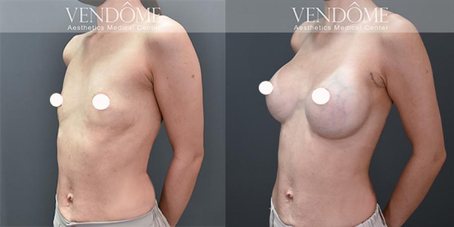 魔滴優點、費用公開！為什麼大家都選擇魔滴隆乳？