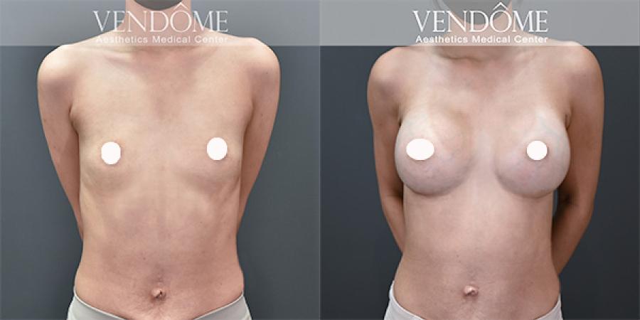 Motiva魔滴隆乳手術案例分享