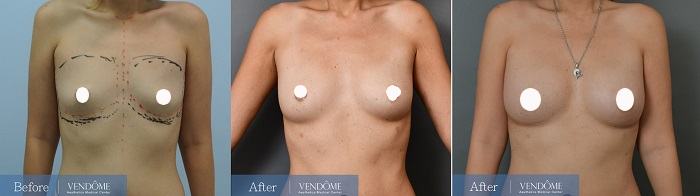 自體脂肪隆乳案例分享A罩杯正面照