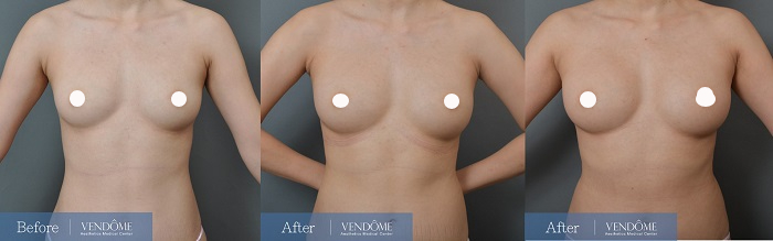 自體脂肪隆乳案例分享大B小C罩杯正面照