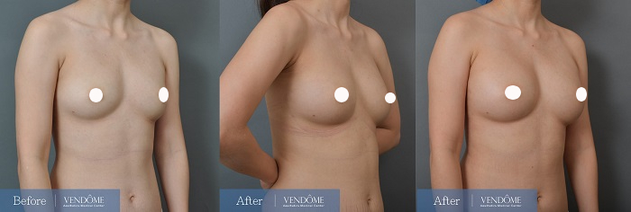 自體脂肪隆乳案例分享大B小C罩杯側面照