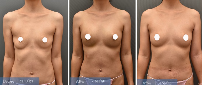 自體脂肪隆乳案例分享產後A罩杯正面照