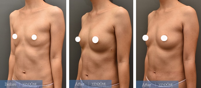 自體脂肪隆乳案例分享產後A罩杯側面照