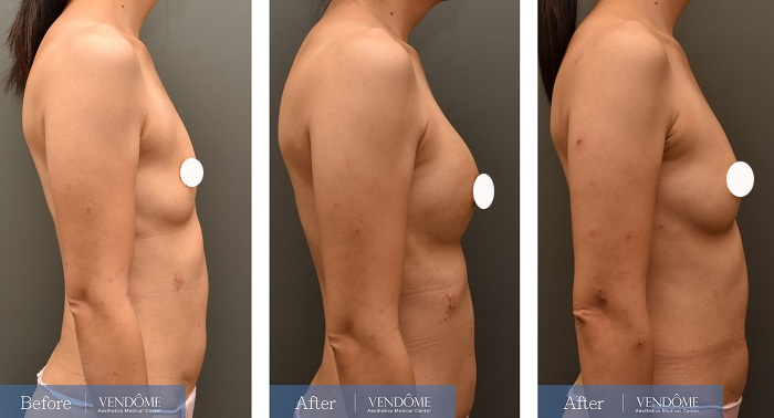 自體脂肪隆乳案例分享產後A罩杯側面照