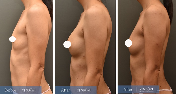 自體脂肪隆乳案例分享產後A罩杯側面照