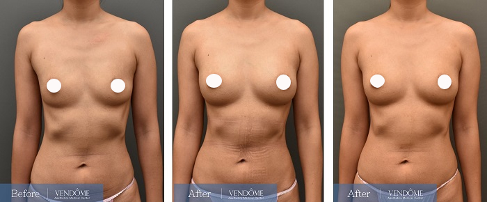 自體脂肪隆乳案例分享產後B罩杯正面照