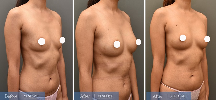 自體脂肪隆乳案例分享產後B罩杯側面照