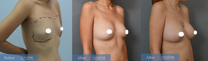 自體脂肪隆乳案例分享A罩杯側面照