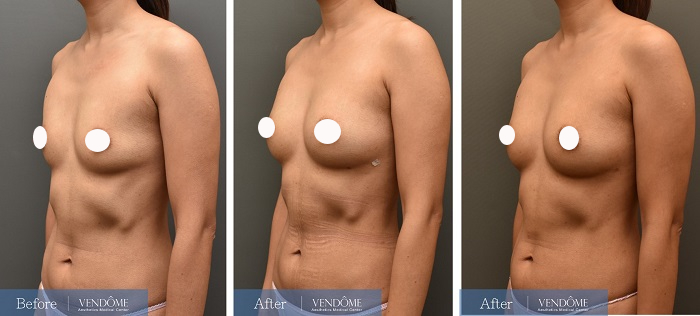 自體脂肪隆乳案例分享產後B罩杯側面照