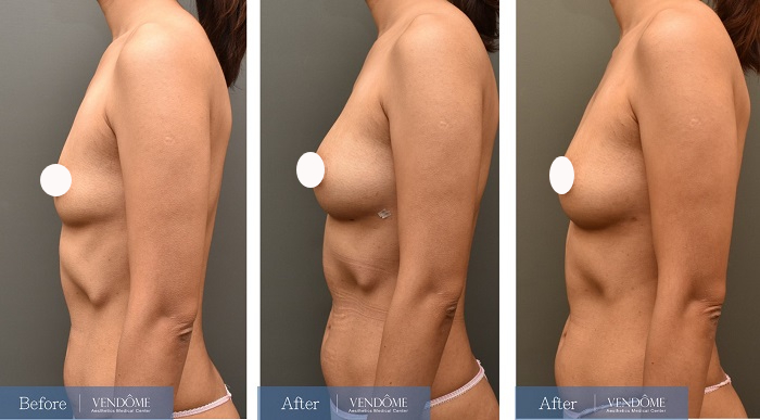 自體脂肪隆乳案例分享產後B罩杯側面照