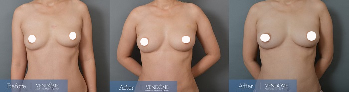 自體脂肪隆乳案例分享產後C罩杯正面照