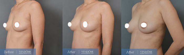 自體脂肪隆乳案例分享產後C罩杯側面照