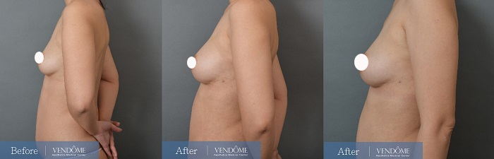 自體脂肪隆乳案例分享產後C罩杯側面照