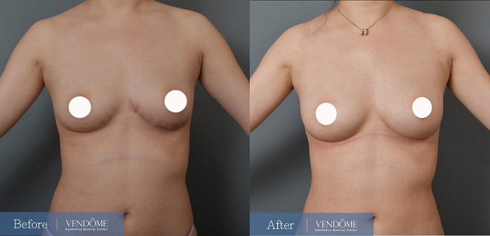 自體脂肪隆乳案例分享產後C罩杯正面照