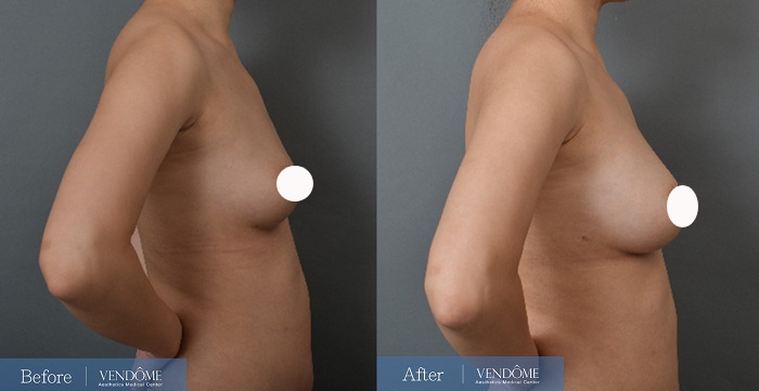 自體脂肪隆乳案例分享產後C罩杯側面照