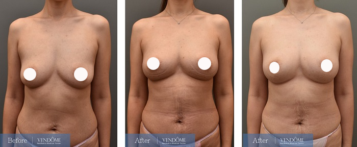 自體脂肪隆乳案例分享D罩杯乳房下垂正面照