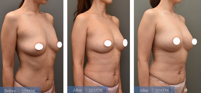 自體脂肪隆乳案例分享D罩杯乳房下垂側面照