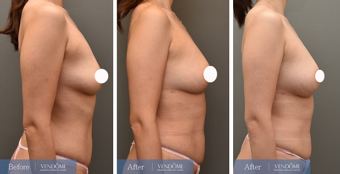 自體脂肪隆乳案例分享D罩杯乳房下垂側面照