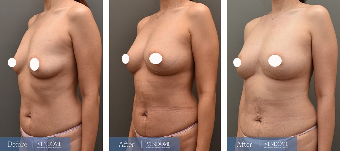 自體脂肪隆乳案例分享D罩杯乳房下垂側面照