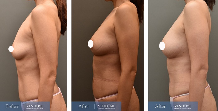 自體脂肪隆乳案例分享D罩杯乳房下垂側面照