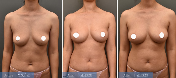 自體脂肪隆乳案例分享D罩杯乳房下垂正面照