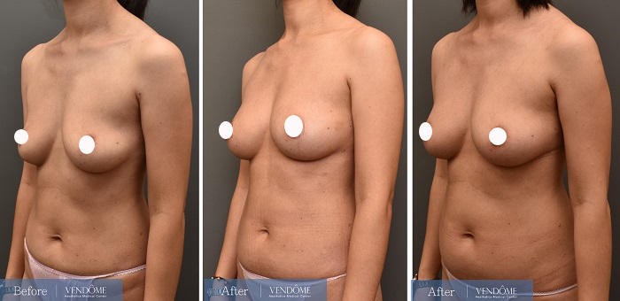 自體脂肪隆乳案例分享D罩杯乳房下垂側面照