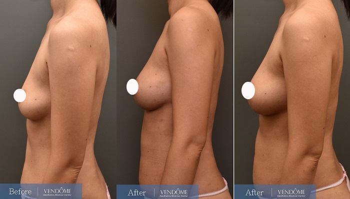 自體脂肪隆乳案例分享D罩杯乳房下垂側面照