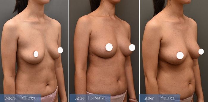 自體脂肪隆乳案例分享D罩杯乳房下垂側面照