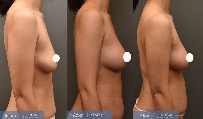 自體脂肪隆乳案例分享D罩杯乳房下垂側面照
